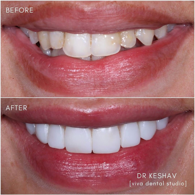 before and after