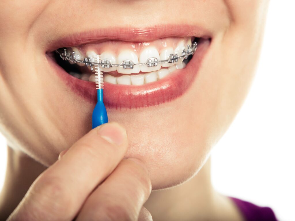 Braces