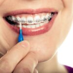 Braces