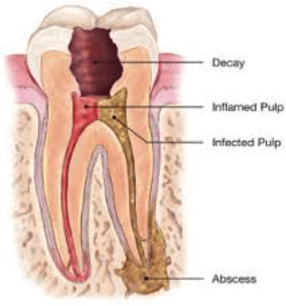 Root Canal treatment Dentist Viva Dental Studio Hornchurch Essex